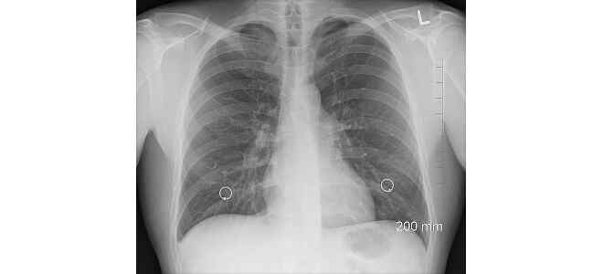 lung
